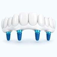 Full arch dental restoration